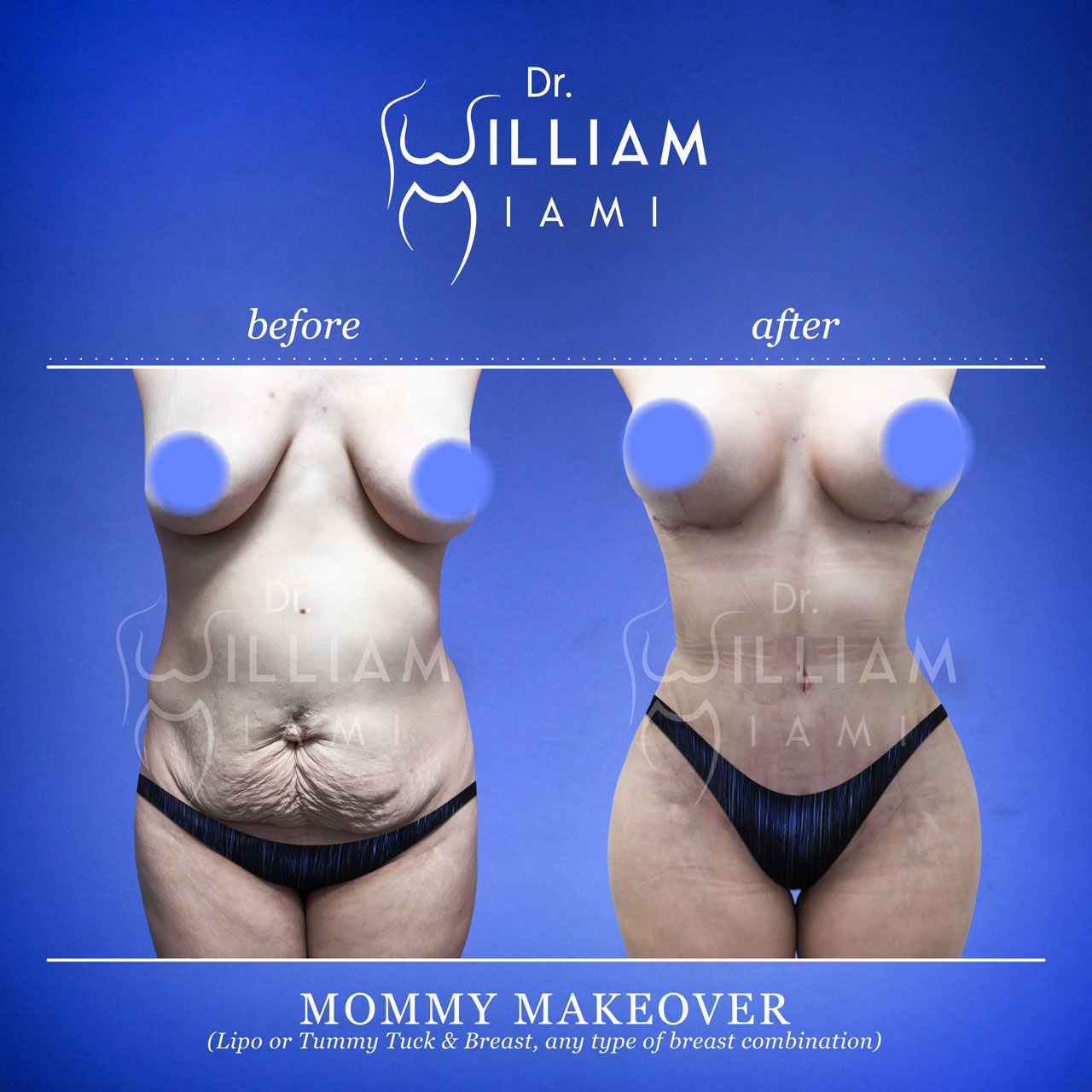 Mommy Makeover Miami - Mommy Makeovers in Miami (Tummy Tuck, Breast Lift &  Liposuction)