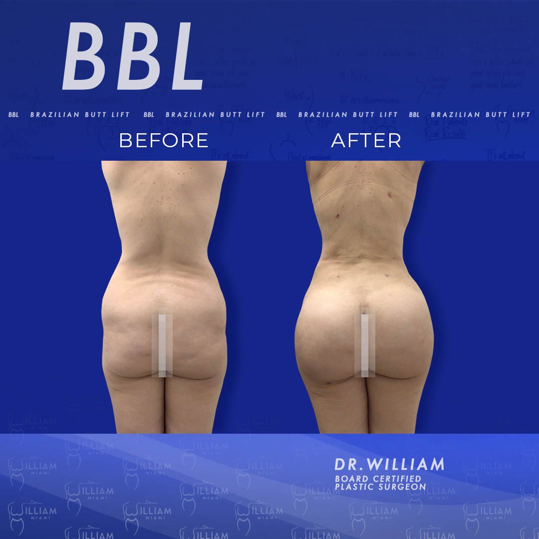 What is a BBL (Brazilian buttocks lift)? - Williams Center